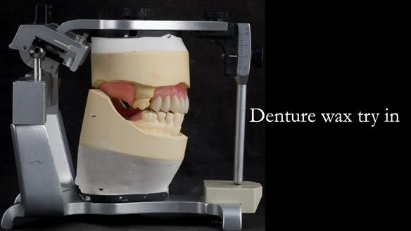 Newsletter 52 Managing Jo’s failing dentition with extractions and Mk 1/Mk 2 complete upper dentures and lower partial dentures FULL PROTOCOL