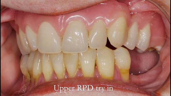 Finlay's Newsletter 58 Gasket upper partial denture for Zoe