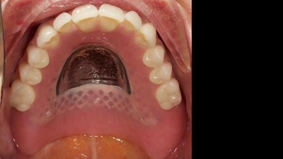Finished dentures - mimicking Mary’s daughters natural teeth