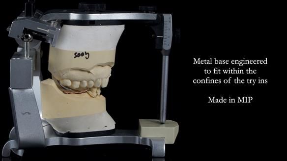 Finlay's Newsletter 61 provision of a lower unilateral free end saddle metal based partial denture for Joyce