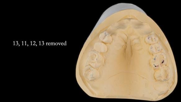 Finlay's Newsletter 63 Case study provision of metal based Scandinavian RPD - functional 10 years on