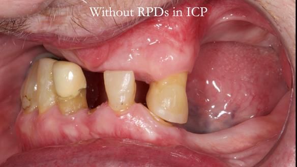 Newsletter 55 Provision of metal based partial dentures for Zephyrine with a repaired cleft lip and palate
