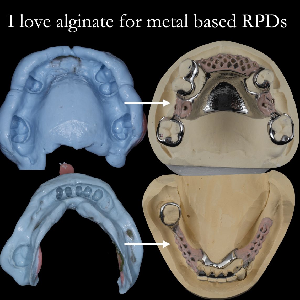 Alginate impression material for metal-based dentures