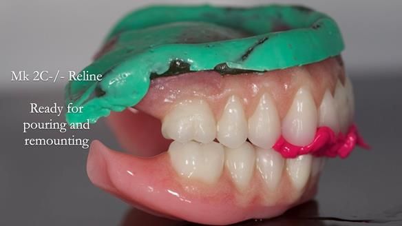 Replacing Madeline’s Complete denture FULL PROTOCOL