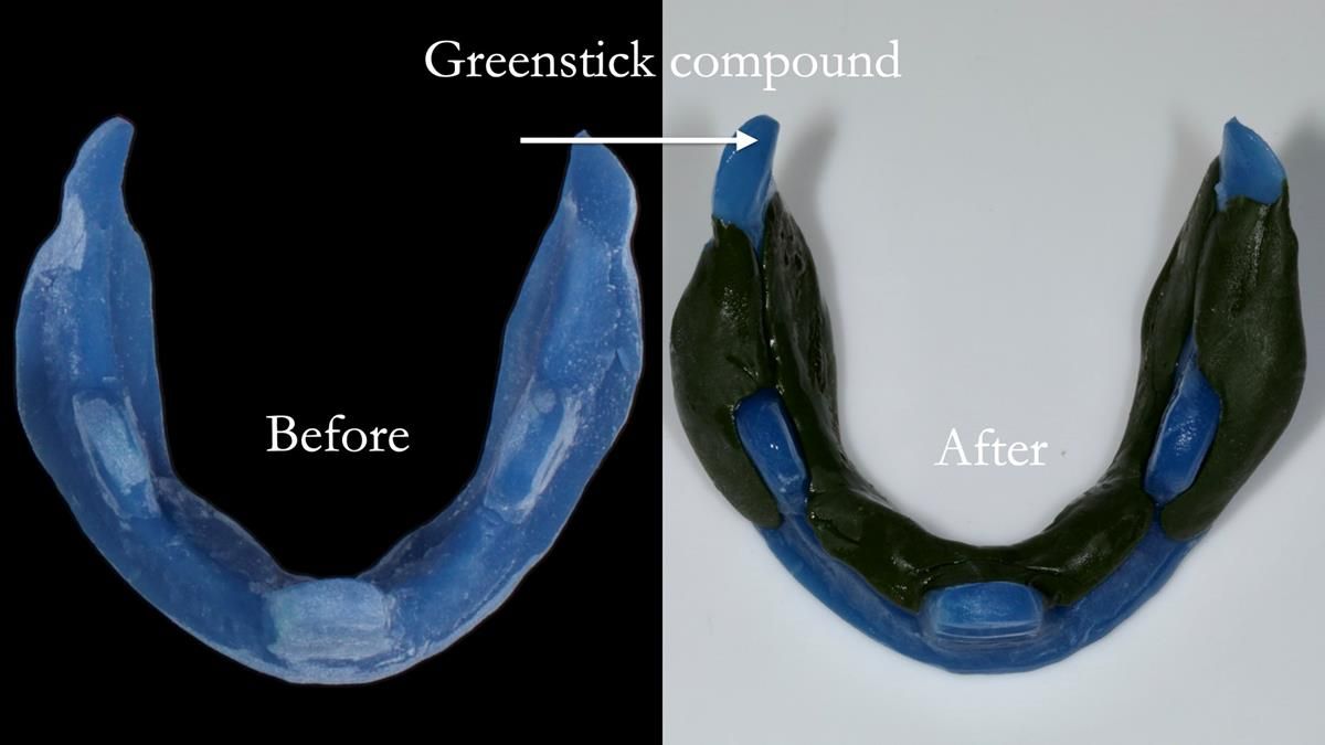Fin’s Newsletter 88 — Complete dentures - full protocol… he rearranged his own teeth!