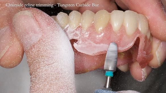 Newsletter 77: Jeremy’s case – immediate complete upper denture