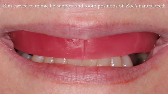 Finlay's Newsletter 58 Gasket upper partial denture for Zoe