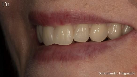 Newsletter 75: Marion’s case - Step-by-step complete denture workflow