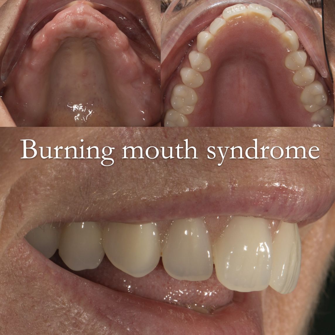 Burning mouth syndrome and other peculiar symptoms