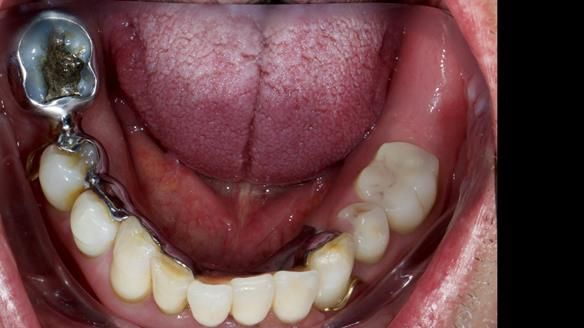 Newsletter 86 Peter the Architect — precision removable partial dentures case study