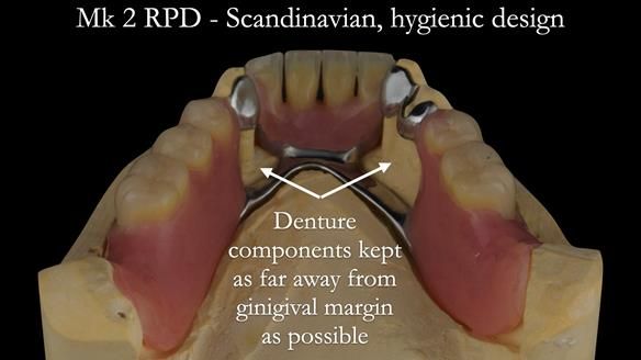 Finlay's Case Study Newsletter 40 - Immediate Mk 1 RPD to Definitive Mk 2 RPD - full protocol