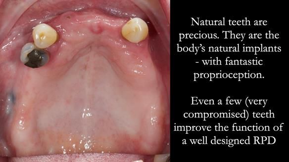 Finlay's Newsletter 59 Ultra hard partial dentures made for Gill