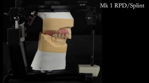 Newsletter 51 Managing Anne’s failing dentition with distal extension base RPD/Splint FULL PROTOCOL