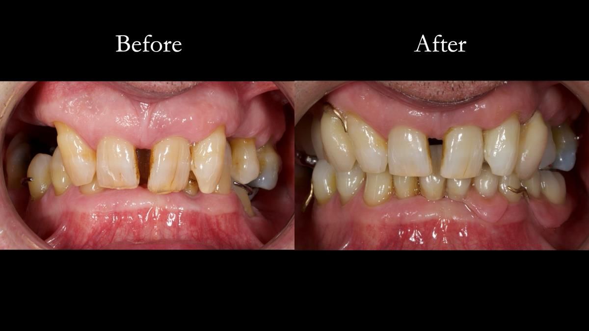 Newsletter 86 Peter the Architect — precision removable partial dentures case study