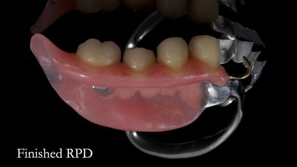 Finlay's Newsletter 61 provision of a lower unilateral free end saddle metal based partial denture for Joyce