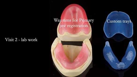 Newsletter 53 showing the making and fitting of ultra life-like dentures for Valena