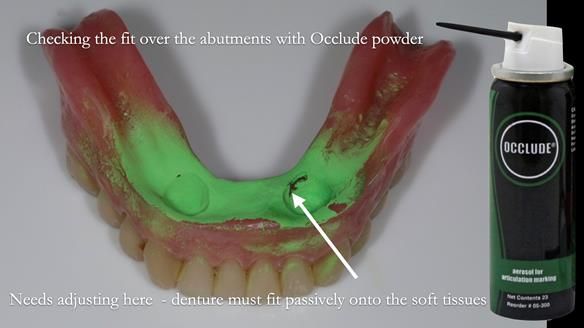 Newsletter 70 Complete Denture Treatment for Kate: A Case Study on Natural-Looking Dentures and Implant-Supported Overdentures