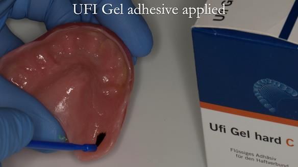 Newsletter 52 Managing Jo’s failing dentition with extractions and Mk 1/Mk 2 complete upper dentures and lower partial dentures FULL PROTOCOL