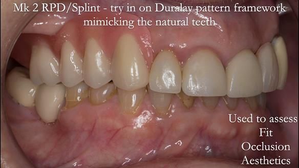 Newsletter 51 Managing Anne’s failing dentition with distal extension base RPD/Splint FULL PROTOCOL