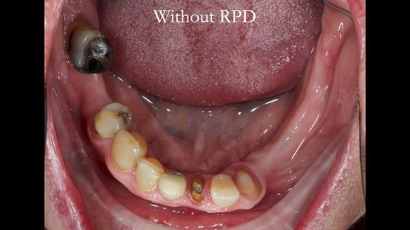 Newsletter 55 Provision of metal based partial dentures for Zephyrine with a repaired cleft lip and palate