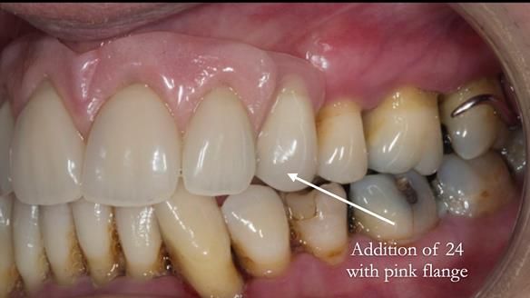 Finlay's Newsletter 63 Case study provision of metal based Scandinavian RPD - functional 10 years on