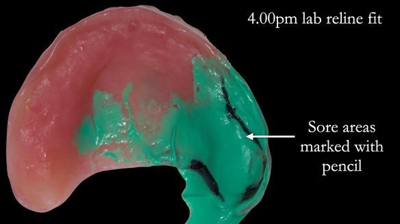 Newsletter 52 Managing Jo’s failing dentition with extractions and Mk 1/Mk 2 complete upper dentures and lower partial dentures FULL PROTOCOL