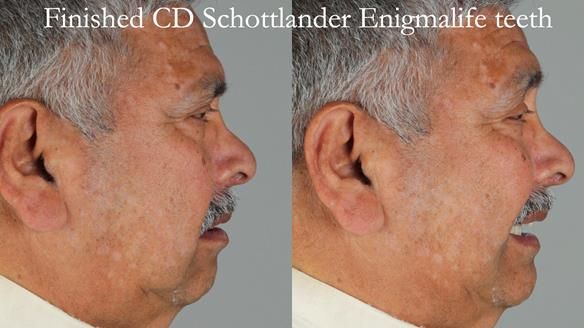 Finlay's Newsletter 62 provision of extractions and metal based complete dentures for Rafique