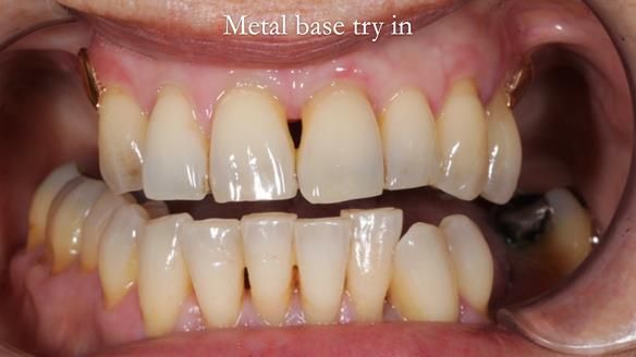 Newsletter 56 showing the making and fitting of a bilateral free end saddle upper removable partial denture (RPD) for patient with pemphigus