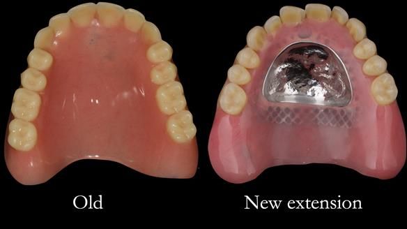Complete denture Class II div 2 deep overbite Newsletter 39