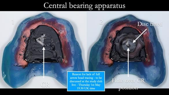 Newsletter 77: Jeremy’s case – immediate complete upper denture