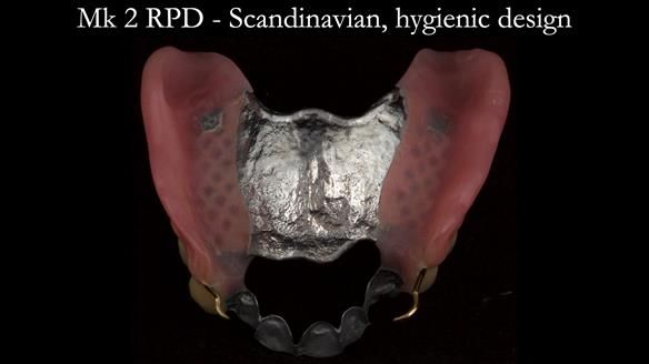 Finlay's Case Study Newsletter 40 - Immediate Mk 1 RPD to Definitive Mk 2 RPD - full protocol