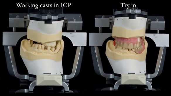 Newsletter 55 Provision of metal based partial dentures for Zephyrine with a repaired cleft lip and palate