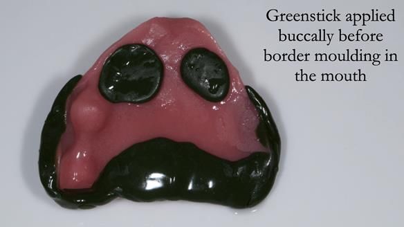 Solving Linda’s Failed “All on 4” implant bridges - full protocol Newsletter 42