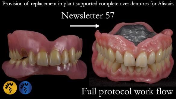 Newsletter 57 showcases the making and fitting process of implant-supported complete dentures for Alisdair