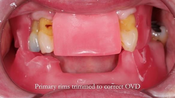 Finlay's Newsletter 59 Ultra hard partial dentures made for Gill
