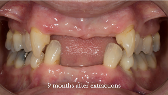 Figure 75 Ridges 9 months after extractions