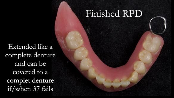 Finlay's Newsletter 59 Ultra hard partial dentures made for Gill