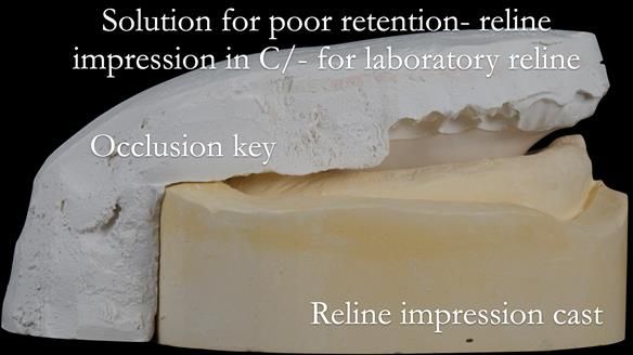 Newsletter 53 showing the making and fitting of ultra life-like dentures for Valena