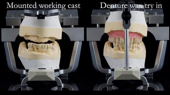 Newsletter 54 case presentation upper complete denture and lower Scandinavian designed hygienic partial denture for David