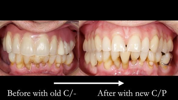 Newsletter 54 case presentation upper complete denture and lower Scandinavian designed hygienic partial denture for David