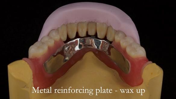 Reinforcement to implant supported dentures is crucial to reduced breakages