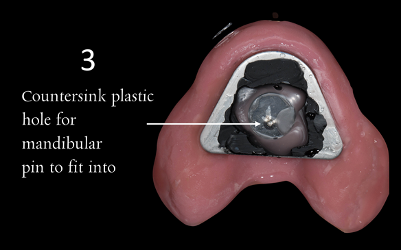 Figure 91 Visit 3 for Mk 2 fabrication. Inter-maxillary registration with central bearing apparatus. Maxillary plate with plastic disc with countersunk hole placed over CR arrow head. This allows the mandibular pin to fit into the hole to enable accurate 