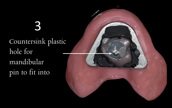 Figure 91 Visit 3 for Mk 2 fabrication. Inter-maxillary registration with central bearing apparatus. Maxillary plate with plastic disc with countersunk hole placed over CR arrow head. This allows the mandibular pin to fit into the hole to enable accurate