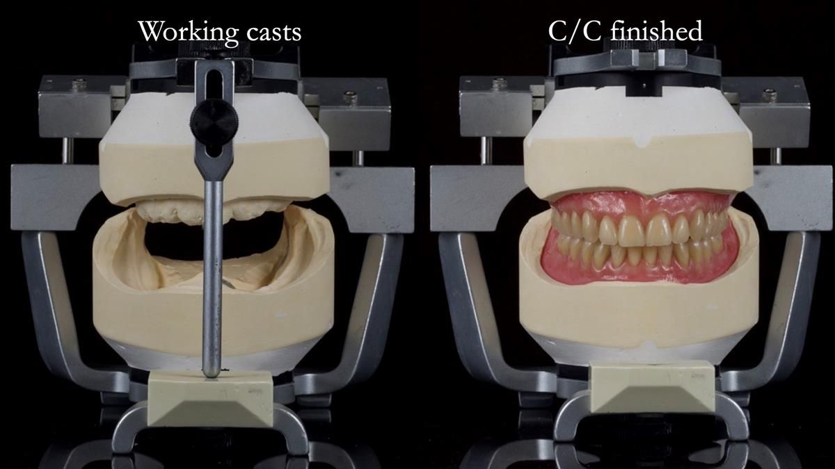 Fin’s Newsletter 88 — Complete dentures - full protocol… he rearranged his own teeth!