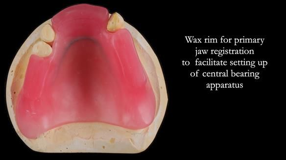 Finlay's Newsletter 59 Ultra hard partial dentures made for Gill