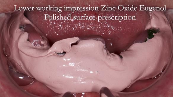Complete denture Class II div 2 deep overbite Newsletter 39
