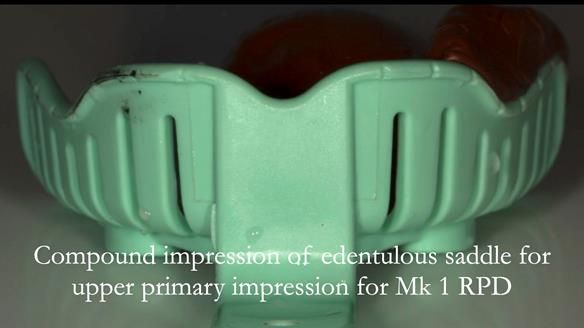 Finlay's Case Study Newsletter 40 - Immediate Mk 1 RPD to Definitive Mk 2 RPD - full protocol