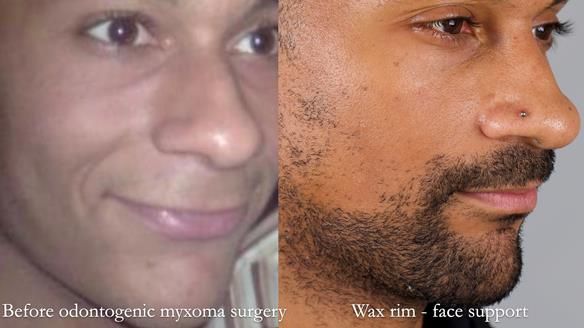 Upper metal base partial denture/occlusal stabilisation splint/obturator - full protocol