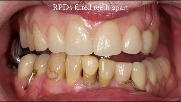 Newsletter 55 Provision of metal based partial dentures for Zephyrine with a repaired cleft lip and palate