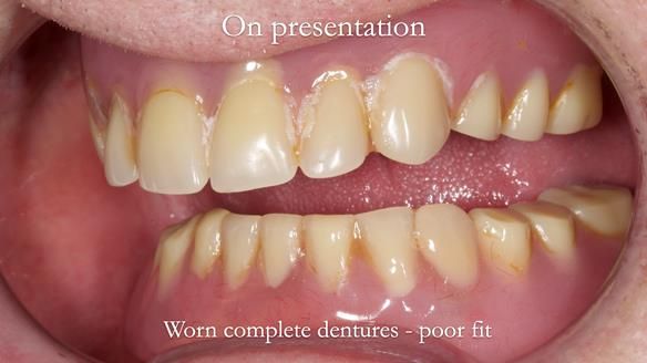 Newsletter 57 showcases the making and fitting process of implant-supported complete dentures for Alisdair